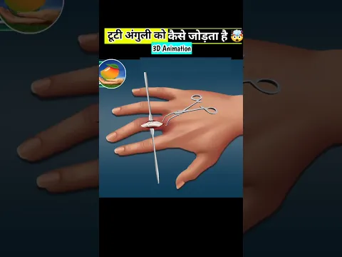 टूटी अंगुली को डॉक्टर कैसे जोड़ता है l how does a doctor fix a broken finger #shorts @BrainzFacts