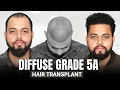 Download Lagu Hair Transplant Success Story (HX-RZAM) | Diffuse Grade 5A Hair Transplant