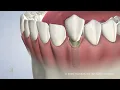 Dental Implants in Naperville IL