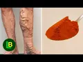 Download Lagu Spataderen en een slechte bloedsomloop zijn verleden tijd als u deze natuurlijke remedie gebruikt