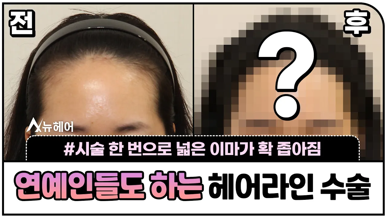 시술 한 번으로 넓은 이마가 확 좁아졌습니다(연예인들도 하는 수술)ㅣ1600모낭ㅣ뉴헤어