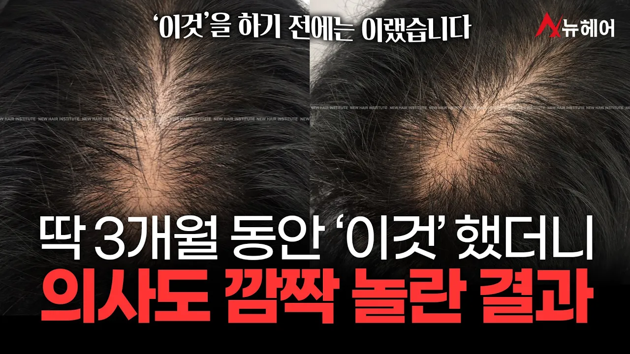 딱 3개월 동안 '이것'했더니 머리숱이 풍성해졌습니다ㅣ뉴헤어
