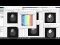 Brain Tumor detection using Matlab machine learning