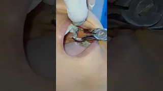 أسرع خلع ضرس عقل في العالم 