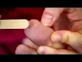 The Best Method for Removing Warts Earth Science