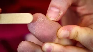 The Best Method for Removing Warts Earth Science