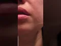 Twitching Lip