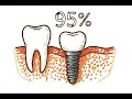 Root Canal Alternatives Explained Cedar Dental Group Renton WA