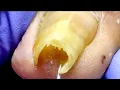 Super Curly Toenails, Curl Them Into A Circle And Trim Them Gently~【Xue Yidao】