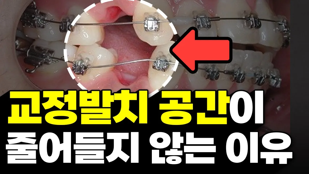 교정 발치한 공간이 줄어들지 않는 결정적 이유. 교정은 교정과 전문의가 따로 있습니다.