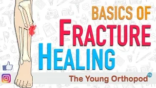 Download Fracture Healing | ANIMATION | BASICS | The Young Orthopod MP3