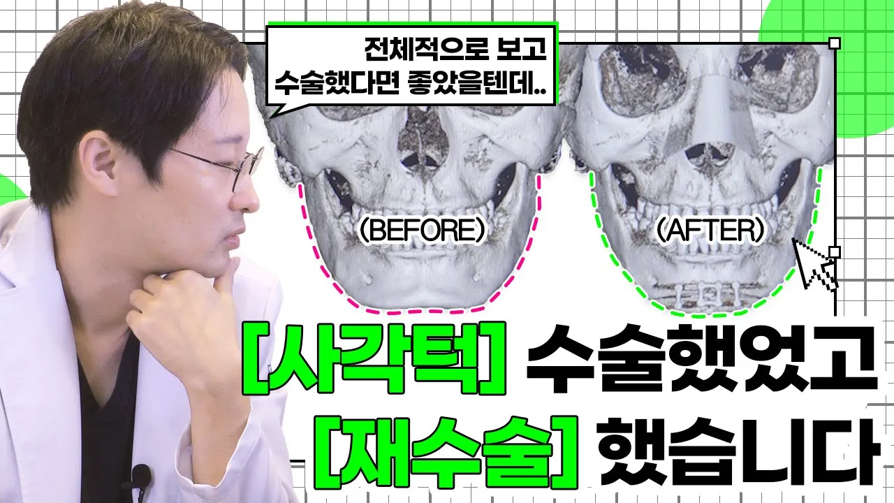 [안면윤곽] 사각턱 수술 했었고, 재수술 했습니다.. 처음 수술부터 계획을 제대로 세웠더라면..  |  윤곽수술 전후 CT