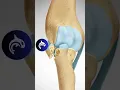 Download Lagu See how a Radial Head Fracture of the Elbow is fixed - 3D Animation