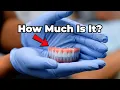 Full Mouth Dental Implant Cost in 2025