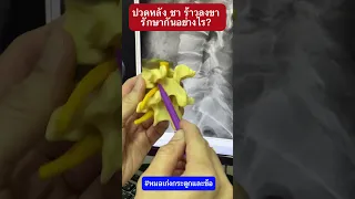  อาการปวดหลังเรื้อรังที่เกิดจากหมอนรองกระดูกเสื่อมหรือกระดูกหัก มีสาเหตุมาจากอะไรบ้าง 