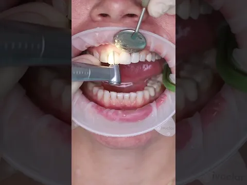 Wax up #shorts #dentist #dental #implant #veneers #short
