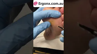Say Goodbye to Foot Pain: Expert Corn & Callus Removal at The Podiatry Clinic #FootCare #Podiatrist
