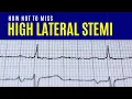 High Lateral STEMI How NOT to miss it
