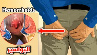 شاهد عملية ازالة البواسير بالجراحة والليزر Hemorrhoids 