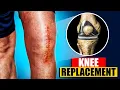 Total Knee Replacement Surgery 3D Animation 3D Animation of a Knee Replacement Joint Replacement