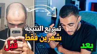 سر تسريع فعالية المنوكسديل - العلاج الوحيد لتساقط الشعر و إنبات اللحية