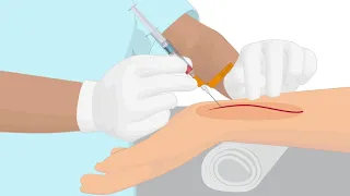 How To Properly Handle An Arterial Puncture Blood Gas Sample 