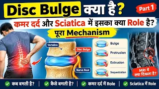 Disc Bulge क्या है? | कमर दर्द और Sciatica में इसका क्या Role है? | पूरा Mechanism | Part 1
