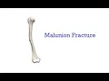 Repair of Malunion CPT code - simplify medical coding