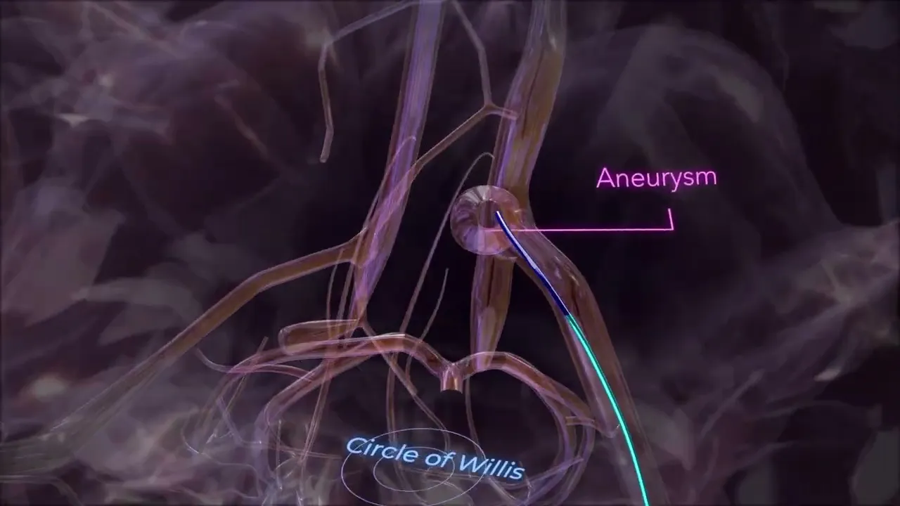 Aneurysm animation