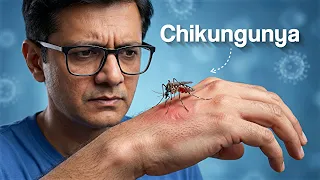 Chickungunya - a viral infection
