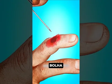 😱 UMA BOLHA GIGANTE? NUNCA ESTOURE ASSIM!
