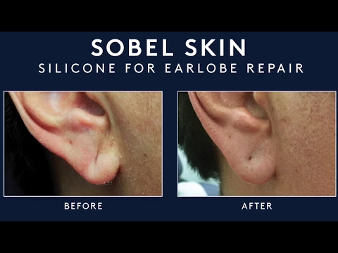 Non-Surgical Earlobe Repair in NYC - Sobel Skin