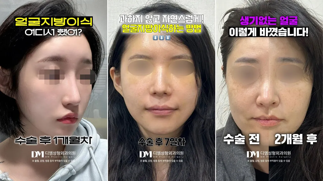 지방이식은 깔끔하고 자연스럽게 | 성형 쇼츠 모음▶️