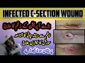 Download Lagu How to Treat an Infected C-Section Wound || Baray Operation K Zakham ke Elaj || Cesarean Infection