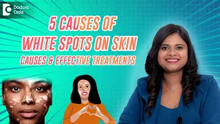 White Spots on Skin - 5 Causes and Treatment Vitiligo Leucoderma Eczema