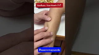  ก้อนที่บริเวณแขนขวาของคนไข้อายุ 40 ปี มีลักษณะอย่างไรที่บ่งชี้ว่าอาจไม่ใช่เนื้อร้าย 