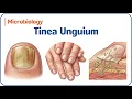 19 Tinea Unguium Onychomycosis Types Diagnosis Treatment for USMLE NEET-PG