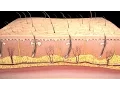 Skin Graft