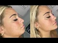 Download Lagu extreme full face filler \u0026 refinement 💉 ⊹ ࣪ ˖ ୨୧ advanced experimental procedures