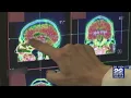 March is brain injury awareness month What is a concussion