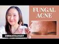 Dermatologist s Guide to FUNGAL ACNE What is it Treatments