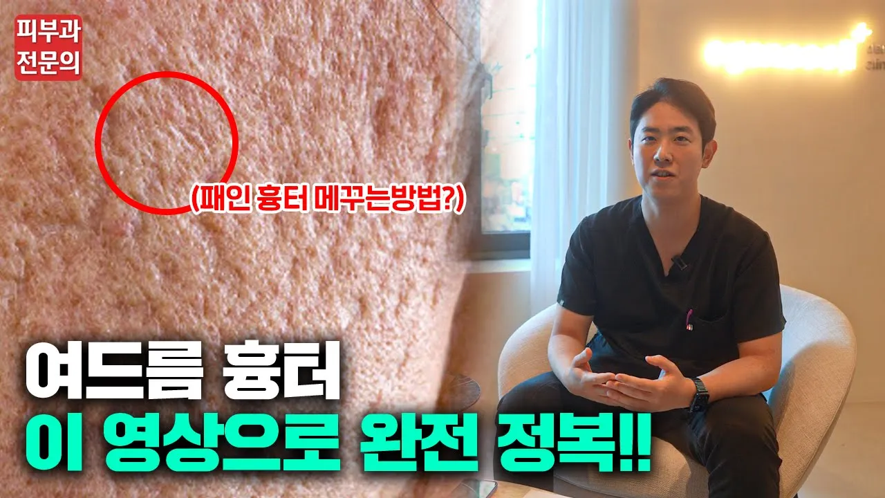 이것만 알고 계시면 여드름 흉터 치료 어디서든 믿고 받으셔도 됩니다 / 흉터 치료의 모든 것