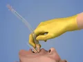 Laryngeal Mask Airway Insertion