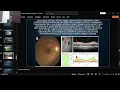 Optic nerve head evaluation in glaucoma management part 2 Disc hemorrhage bayoneting baring etc