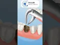 PRISM Dental Clinic - Tooth Extraction