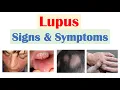 Download Lagu Lupus Signs \u0026 Symptoms (\u0026 Why They Occur) | Skin, Joints, Organ Systems