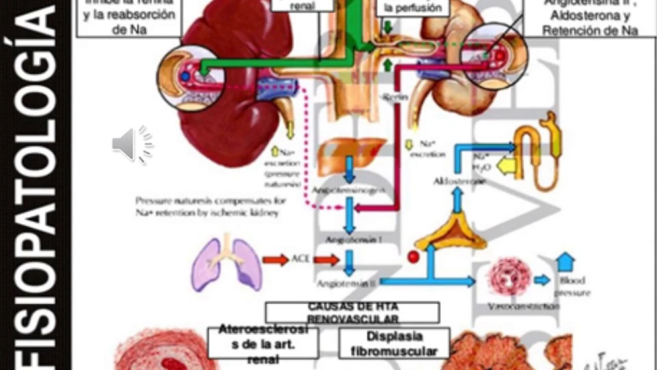 Enfermedad Vascular Renal
