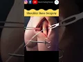 Download Lagu Shoulder injury #shorts #doctor