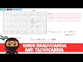 Download Lagu Rate and Rhythm | Sinus Bradycardia and Sinus Tachycardia
