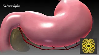 جراحی اسلیو معده 